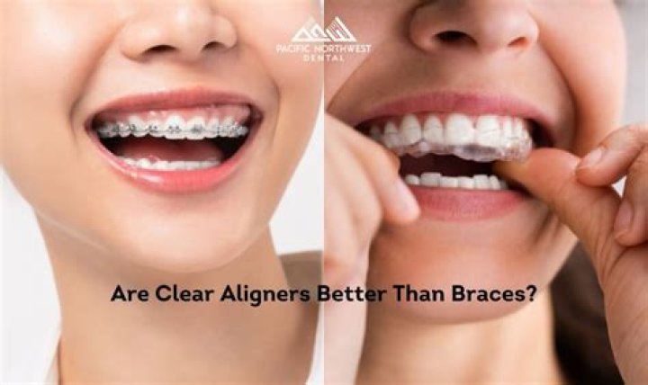 Are clear aligners better than braces?
