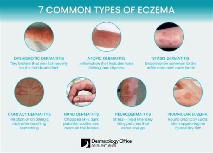 Can eczema turn into sepsis?