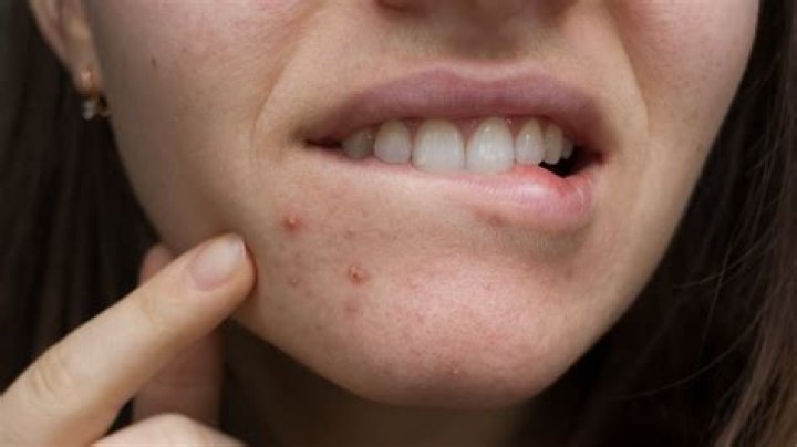 Can jaggery cause pimples?