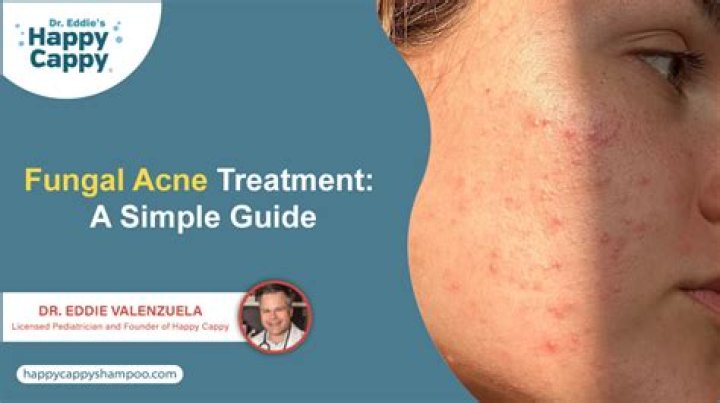 Can spit cure acne?