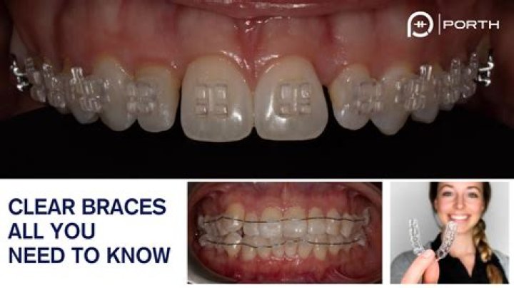 Do clear braces look weird?