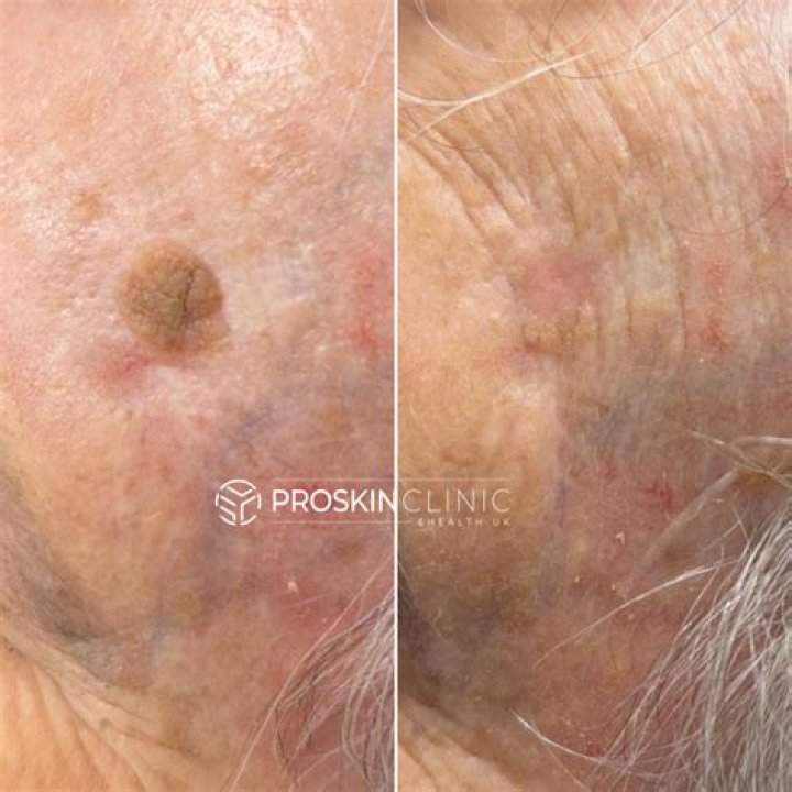 Do seborrheic keratosis grow over time?