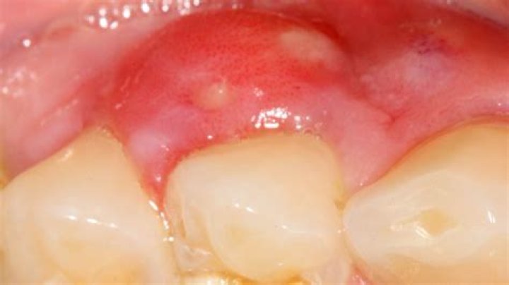 Does throbbing gums mean infection?