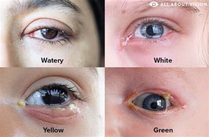 How can I get white eyes fast?