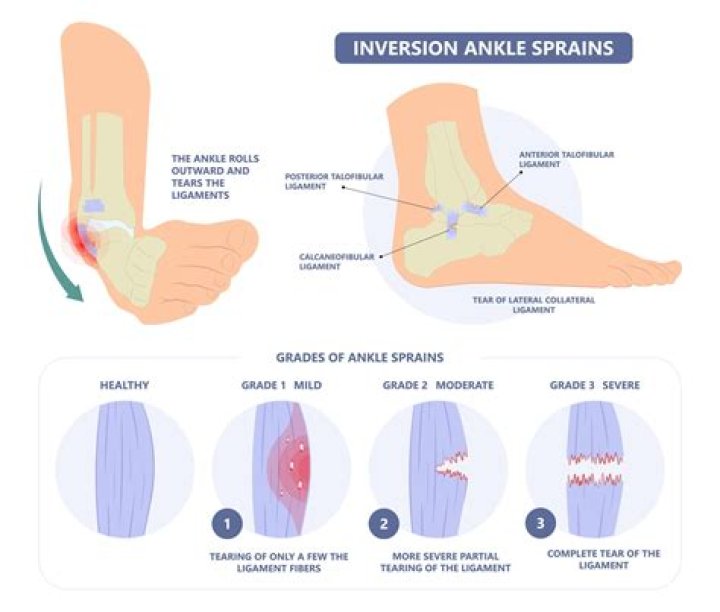 How long can a foot sprain last?