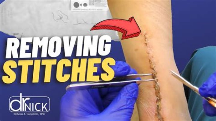 Is it painful to remove C-section stitches?