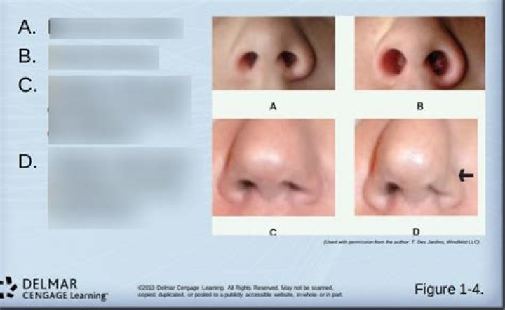 Is nasal voice genetic?