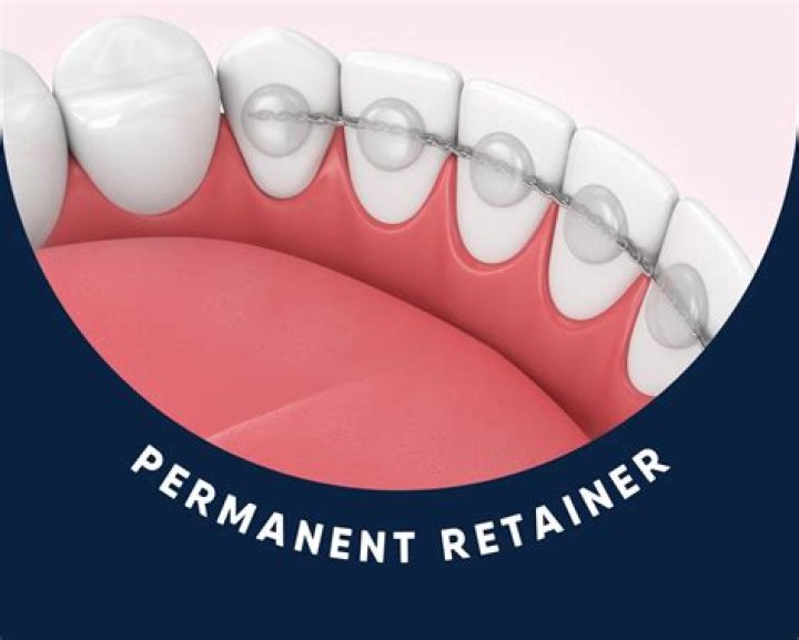 Should I store my retainer in water?