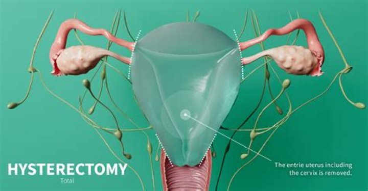 Should you have a hysterectomy if you have HPV?