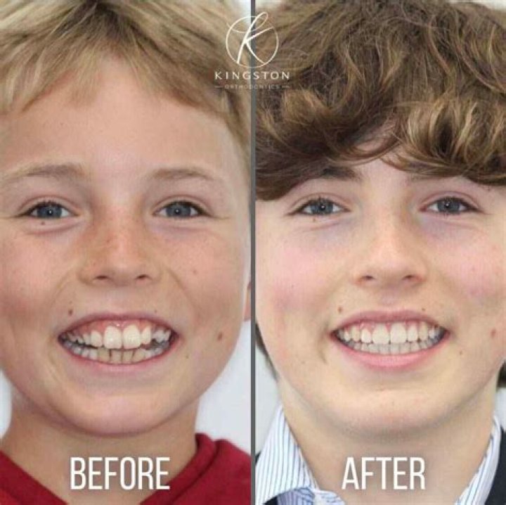 When are you too old to have braces?