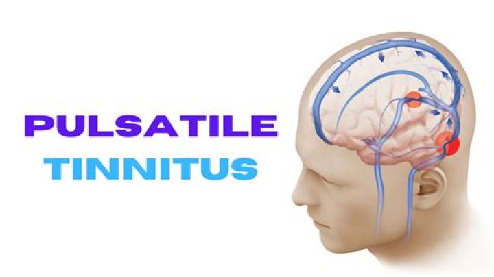 Why is my pulsatile tinnitus worse at night?